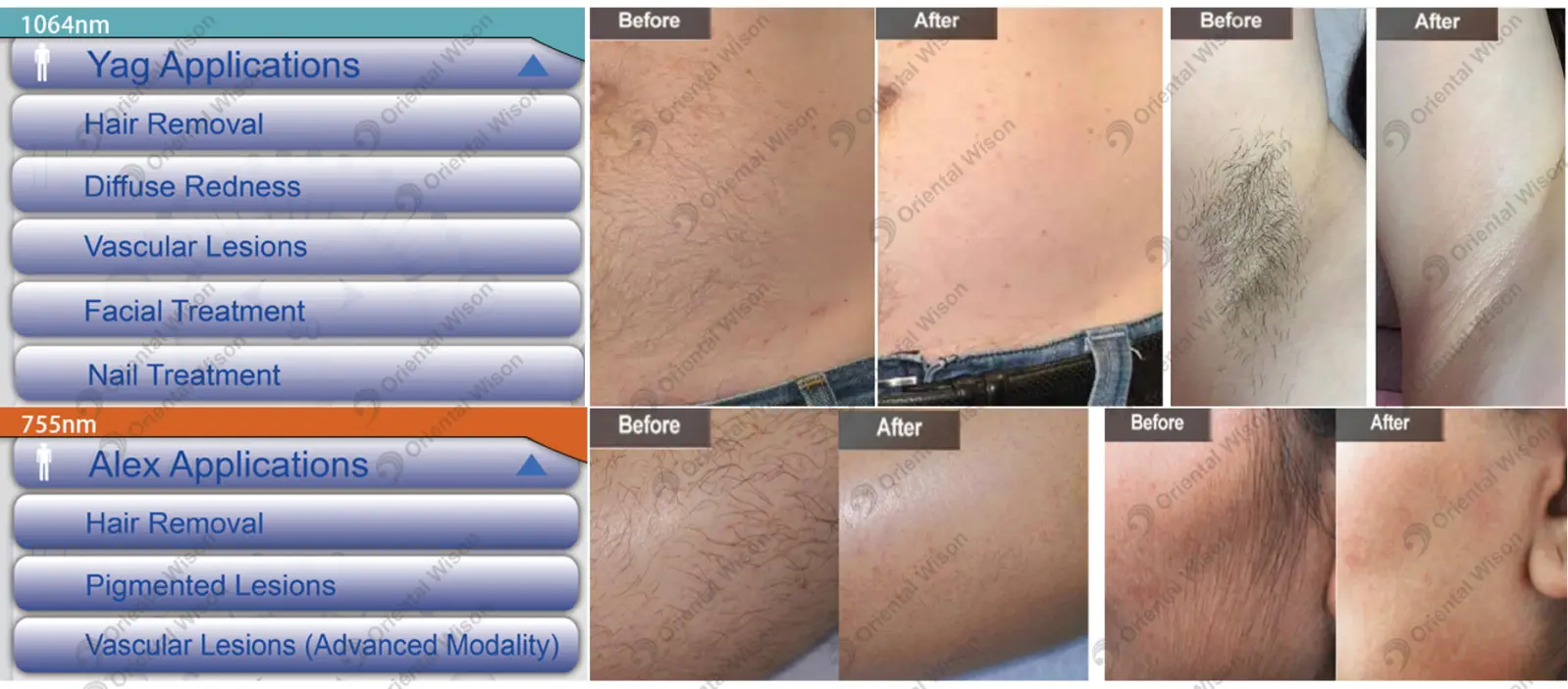 Alexway Laser Hair Removal Machine