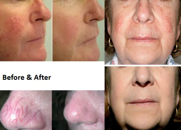 980nm 1470nmdiode Laser Lipolysis Machine